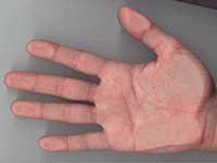 hand palm skin